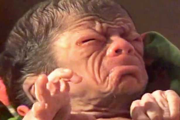 PAY-A-baby-boy-who-was-born-with-a-condition-called-Progeria-in-Bangladesh (1)