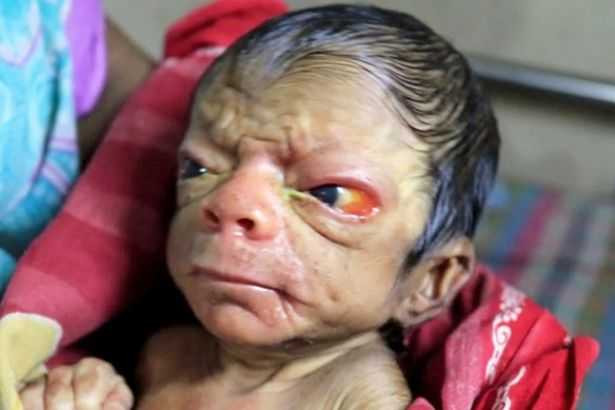 PAY-A-baby-boy-who-was-born-with-a-condition-called-Progeria-in-Bangladesh (2)