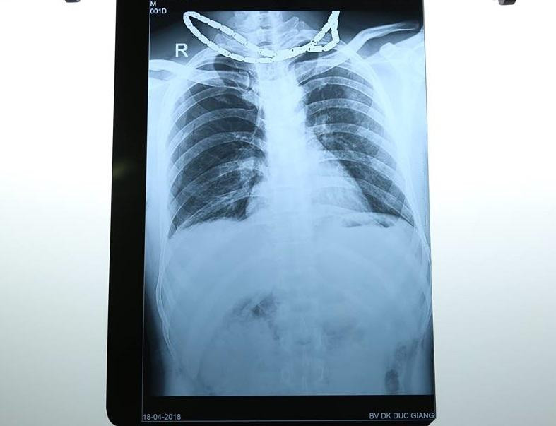 cap-cuu-nhieu-vet-thuong