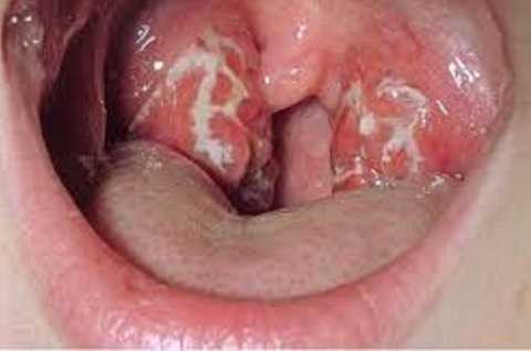 benh-bach-hau-khien-3-nguoi-tu-vong-nguy-hiem-the-nao-hinh-2