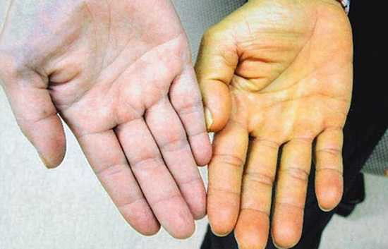 dau-hieu-ung-thu-gan1