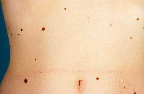 500x329xung-thu-da-8.jpg.pagespeed.ic.FhPwelWGI-