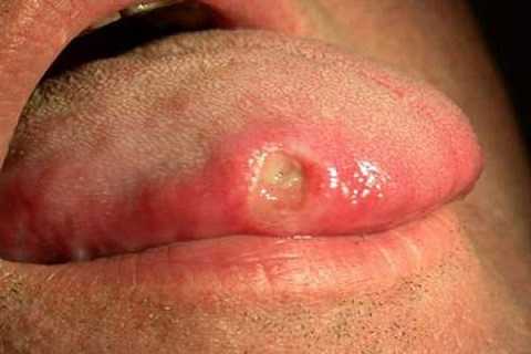 canh-bao-dau-hieu-ung-thu-luoi-bat-ngo-ban-nen-biet-hinh-4