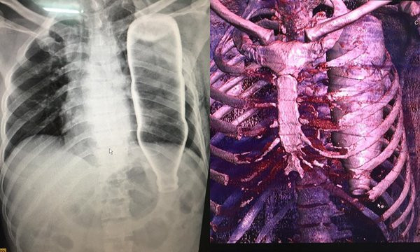 hy-huu-nhat-nam-bat-day-khi-dang-lo-ma-chai-chui-tot-long-nguc