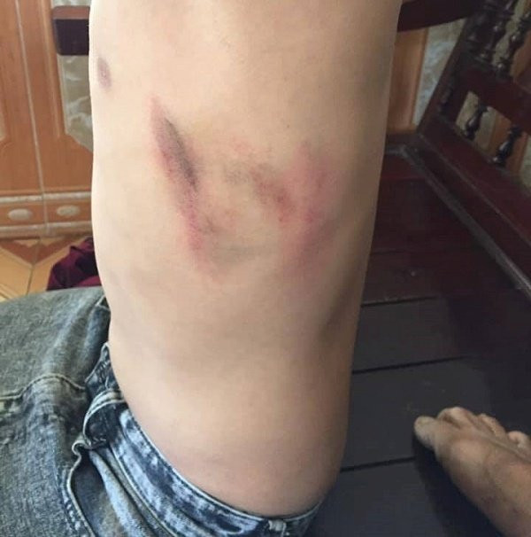 vet thuong tren em T 11