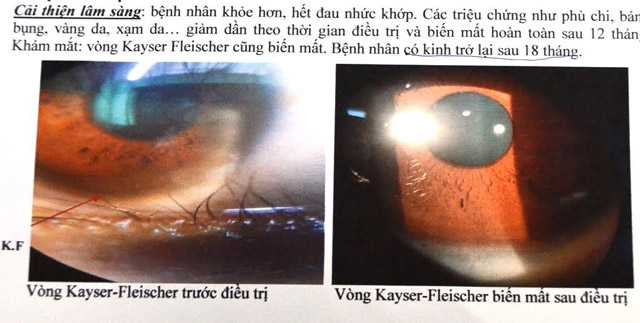 lai phat hien benh lao gan hiem gap dau tien o vn va thu 2 the gioi hinh anh 2