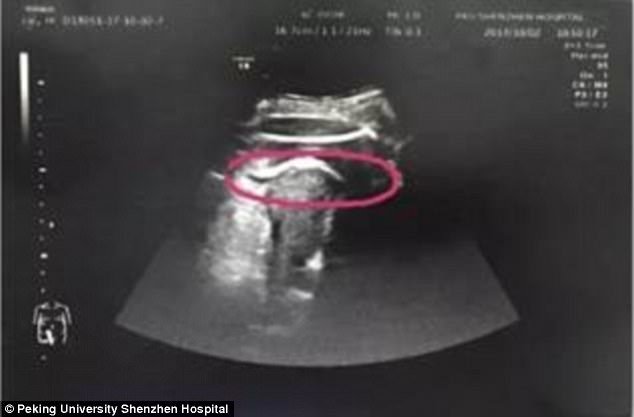 4538E5B400000578-4969360-The_Peking_University_Shenzhen_Hospital_shared_the_above_picture-a-6_1507714528209