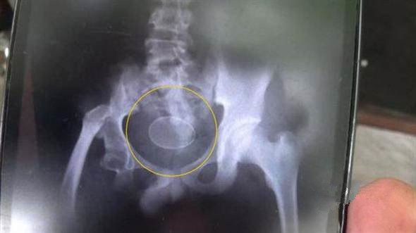 cau-be-de-trung-1(1)