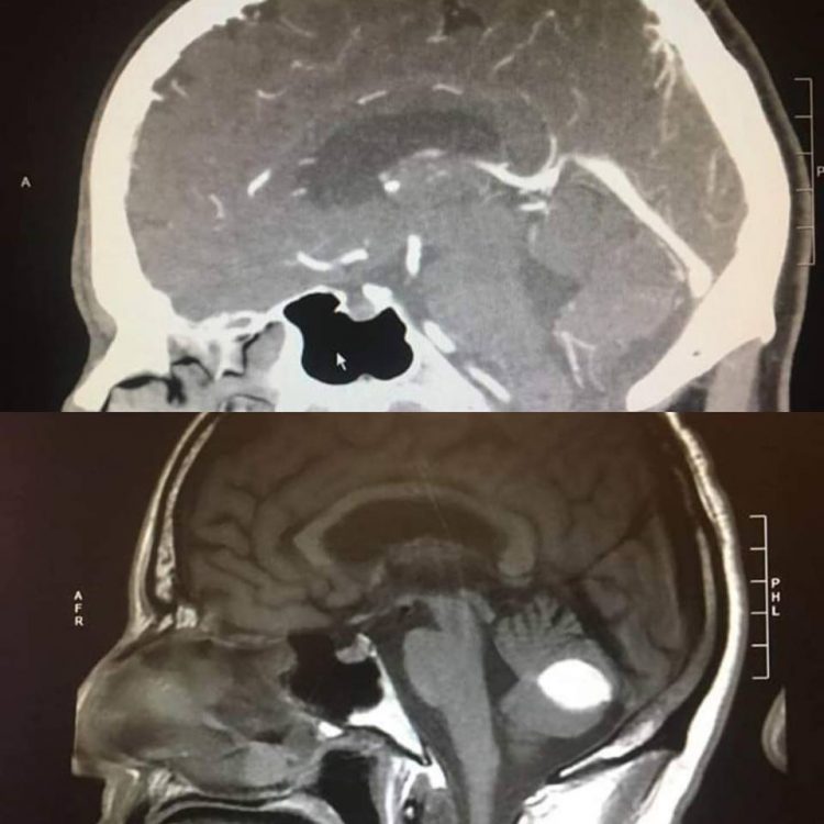 dissapearing-tumor-750x750