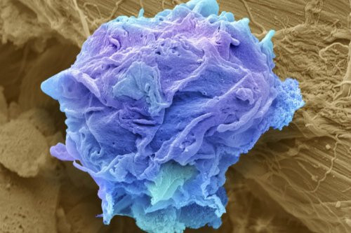 Tế bào ung thư. Ảnh: medicalinsider