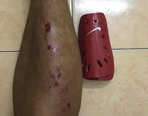 cau-thu-hai-phong-so-den-mat-ngu-khi-bi-vao-bong-bang-hai-chan