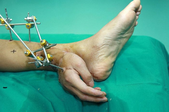 Một chàng trai đã được tái tạo bàn tay thành công sau khi các bác sỹ cấy ghép bộ phận này vào mắt cá chân của anh suốt hơn 1 tháng để tránh bị hoại tử.