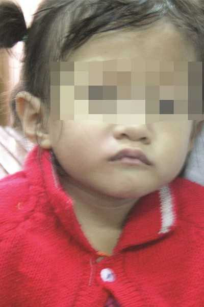 Cháu T.T.H. - là nạn nhân của những chai xi rô Théralence.