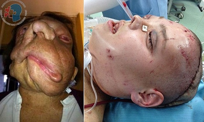 Khuôn mặt của Joana trước và sau cuộc phẫu thuật kéo dài 23 tiếng