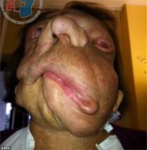 Những khối u khiến khuôn mặt cô gái có hình thù kỳ dị, gặp khó khăn trong quá trình nhai, nuốt và nói chuyện