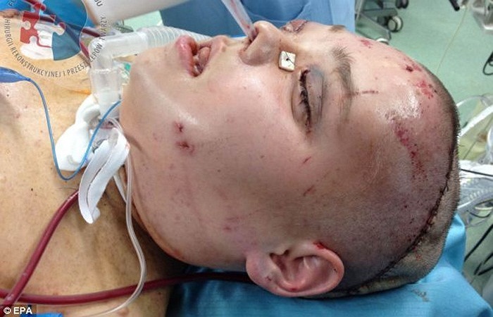 Sau 23 giờ phẫu thuật, 80% da mặt của cô đã được thay thế