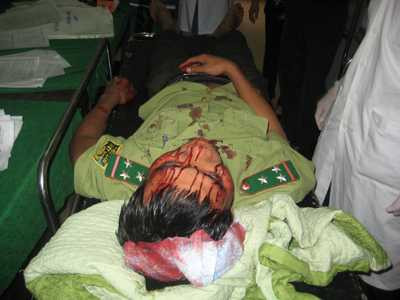 Một cán bộ kiểm lâm bị lâm tặc hành hung. Ảnh: Báo Quảng Bình. 