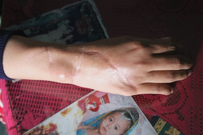 Cô gái bị giang hồ chặt tay cướp xe SH giờ ra sao?