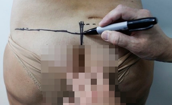 Bác sỹ đang đánh dấu những vùng được cho là sẽ mổ ra để lấy túi silicon khỏi cơ thể bệnh nhân.