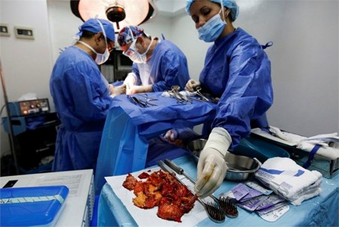 Các mô bị nhiễm trùng kèm chất lỏng silicon được lấy ra từ cơ thể bệnh nhân.