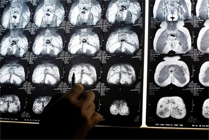 Các bức ảnh X-quang chỉ ra rõ các vùng bị nhiễm trùng trên người của chị Parejo.