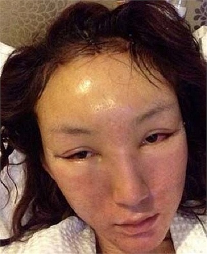 Cô vừa trải qua những ca phẫu thuật thẩm mỹ tại Hàn Quốc nên gương mặt mộc của cô khiến nhiều người sốc nặng với đôi mắt sưng phù, gương mặt cứng đờ, hoàn toàn mất cân đối. 