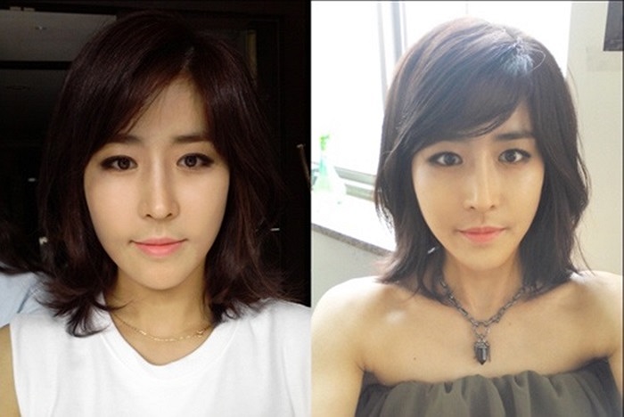Vẻ đẹp hoàn hảo của Huyn Jang Jin sau phẫu thuật