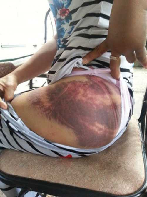 Một phụ nữ tố bị chồng đánh đập dã man