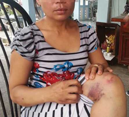Một phụ nữ tố bị chồng đánh đập dã man