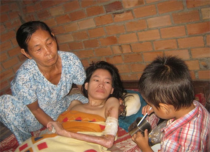 Chị Nguyễn Thị Thắm (mẹ bé Gia Huy) bị cụt tay phải, tay trái teo lại như một khúc xương khô và phải ăn nằm một chỗ chờ chết vì gãy đốt sống sau tai nạn giao thông. 