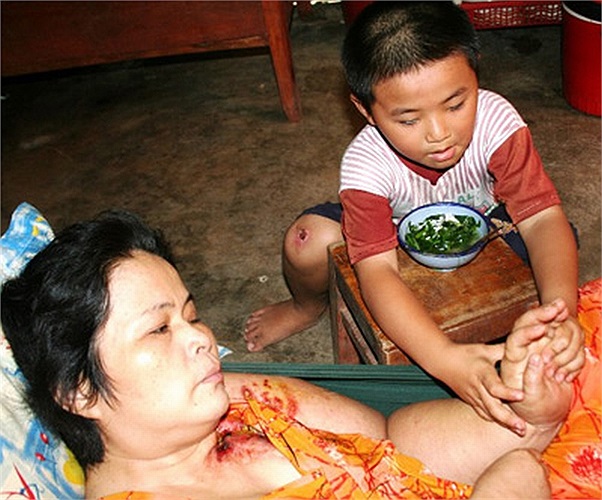 Đây là hoàn cảnh cực kỳ khó khăn của gia đình Chị Võ Thị Mến, 45 tuổi, nguyên là giáo viên trường cấp 2 TX Tây Ninh. Năm 2007, chị phát hiện mình bị ung thư đã di căn. Chồng bỏ nên chỉ có 2 mẹ con chăm sóc nhau.