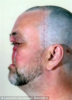 Ông quyết định phẫu thuật cắt bỏ ung thư biểu mô ameloblastic cùng với một phần khuôn mặt. 