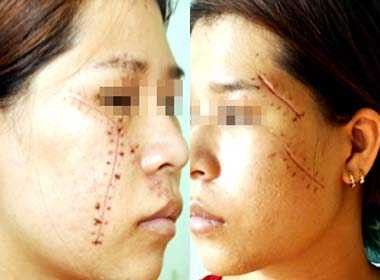 Người phụ nữ bị rạch hơn 15 nhát vào mặt, cổ, đầu