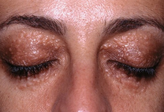 Syringomas là u tuyến lành tính, kích thước từ 1-2 mm, màu da hoặc màu vàng, xảy ra chủ yếu ở phụ nữ. Nó xuất hiện thường xuyên nhất trên mí mắt và trên mặt, rốn, ngực và âm hộ.