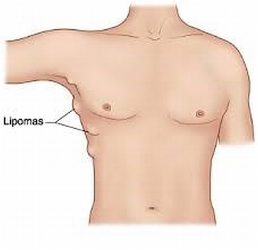 Lipomas (u mỡ) là các khối u dưới da lành tính, dễ dàng nhận ra vì mềm mại, tròn. Chúng thường xuất hiện ở cổ, các chi hay bất cứ nơi nào trên cơ thể. 