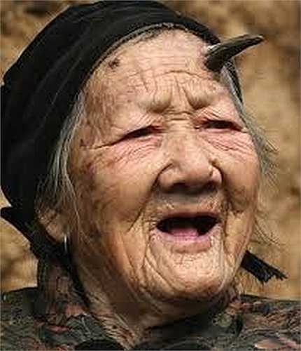 Sừng da xuất hiện như hình phễu kéo dài từ một chấm đỏ trên da. Kích thước và hình dạng có thể thay đổi đáng kể, nhưng hầu hết là dài vài mm.