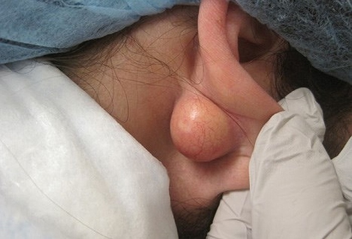 U nang (EIC), còn được gọi là u nang bã nhờn và nang biểu bì, là dạng thường gặp nhất của da. Nó có kích thước từ vài mm đến vài cm và có nguồn gốc từ phễu nang.