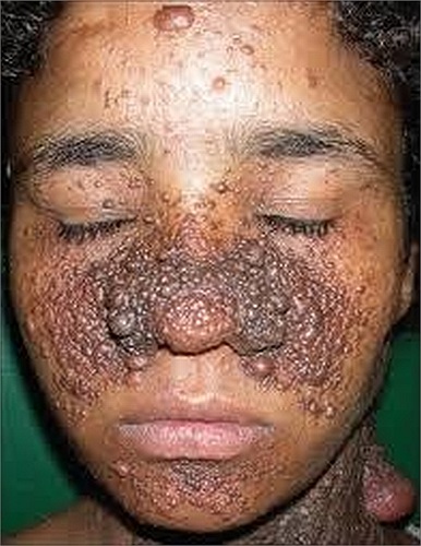 Angiofibroma là một nhóm các tổn thương bao gồm mụn da cây xơ, angiofibroma mặt, u tuyến sebaceum, xơ periungual, và khối u Koenen.