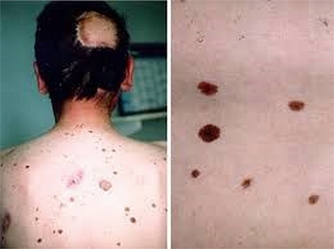 Nevus loạn sản: có xu hướng lớn hơn so với nốt ruồi bình thường, thường được pha trộn màu sắc với số lượng lớn. Một nevus loạn sản có thể làm phát sinh khối u ác tính.