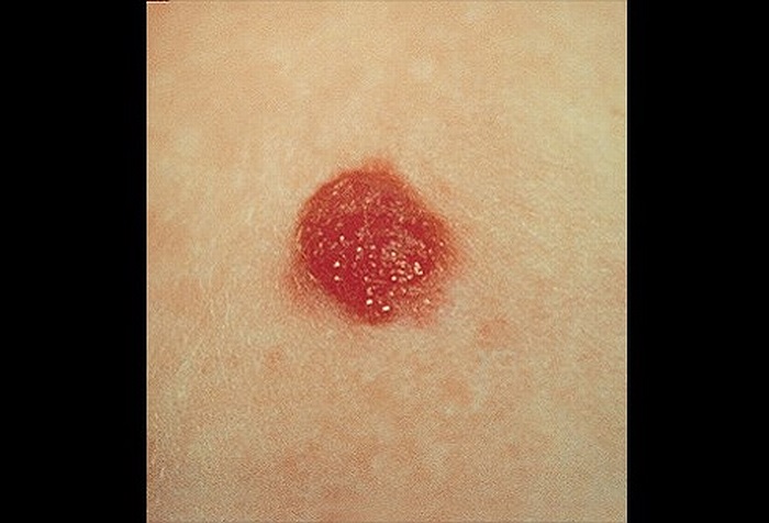 Spitz nevus: nốt ruồi 1cm màu đỏ hình vòm đột nhiên xuất hiện trên vai của một đứa trẻ.