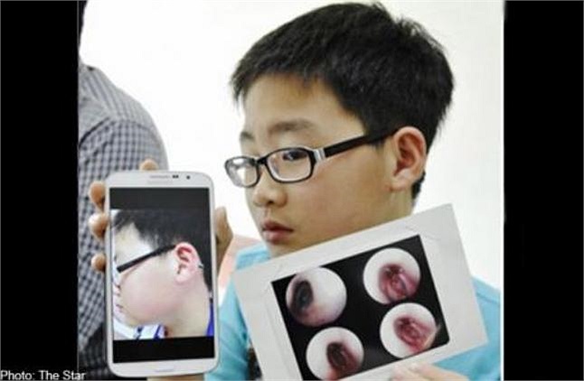 Trước đó, một bé trai 11 tuổi bị giáo viên tát mạnh vào mặt đến nỗi thủng một bên màng nhĩ.