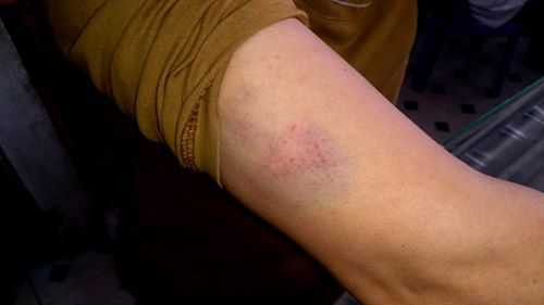  Một trong những viết thương trên cơ thể chị Nga