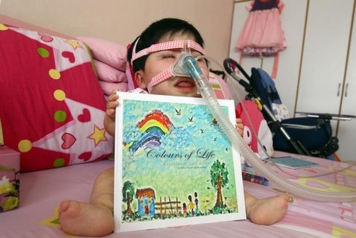 Đó cũng là lúc bác sĩ nhận thấy các chi của cô bé ngắn hơn so với bình thường. 