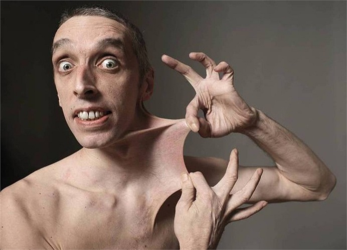 Do mắc chứng bệnh hiếm gặp Ehlers Danlos gây rối loạn các mô liên kết ảnh hưởng đến da, Garry Turner (Anh) có thể căng da bụng giãn ra 15,8 cm. Garry đã được kỷ lục Guinness thế giới công nhận là người có làn da co giãn nhất thế giới.