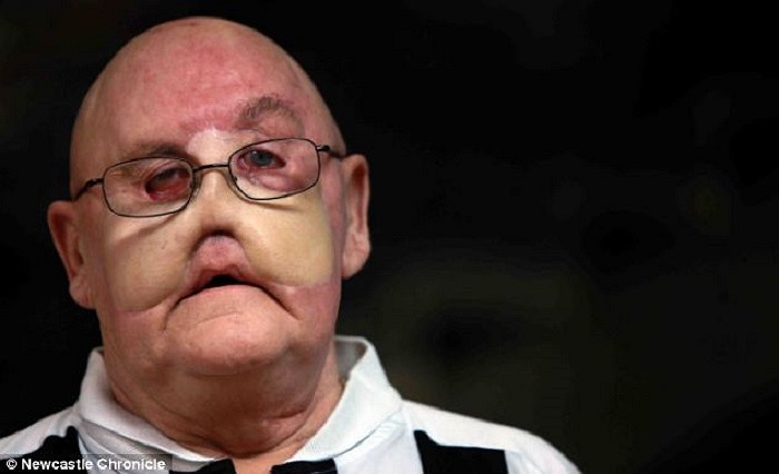 Ông Raymond Martin, 63 tuổi, từ Scotswood, Newcastle, Anh đã mắc chứng bệnh ung thư hiếm gặp - ung thư niêm mạc bên trong của mạch máu. Ông buộc phải cắt đi một nửa gương mặt để cứu mạng sống của mình.