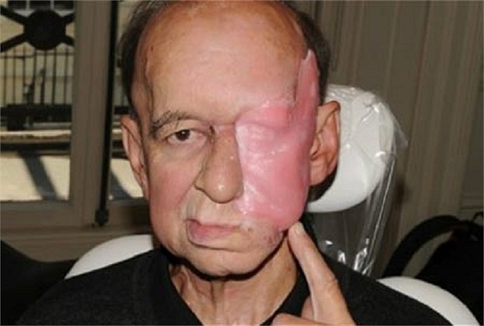 Ông Eric Moger (Anh) đã có một khuôn mặt mới sau khi mất một nửa mặt bên trái do phải cắt bỏ 1 khối u lớn.