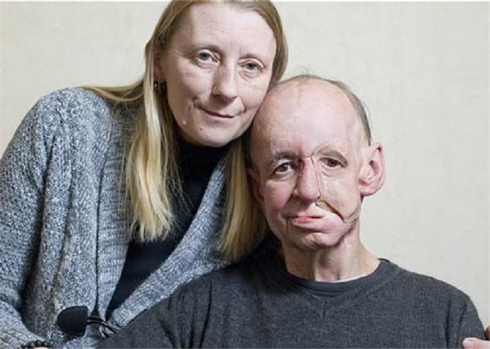 Ông Moger phải chấp nhận mất gần như toàn bộ phía bên trái của khuôn mặt. Qua nhiều cuộc phẫu thuật, khuôn mặt của ông đã được tái tạo.