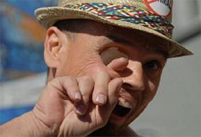 Billy Owen, một công nhân cơ khí, đã bị mất 1 nửa khuôn mặt sau khi bị mắc căn bệnh ung thư năm 2009. Khối u đã di căn và ảnh chỉ còn 10% cơ hội sống sót.