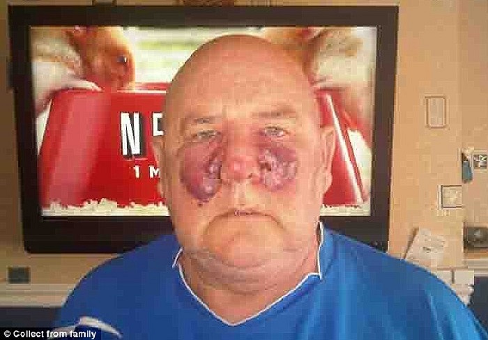 Nhưng nốt này bắt đầu lây lan rất nhanh, bác sĩ lúc đầu cho rằng đây có thể là phát ban hoặc nhiễm trùng. Rồi ông không thể tin mình đã bị ung thư. 