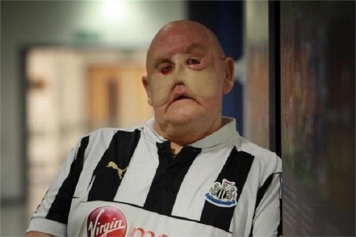 Phải mất một số tuần, ông Martin mới lấy hết can đảm để nhìn vào mình trong gương sau cuộc phẫu thuật.